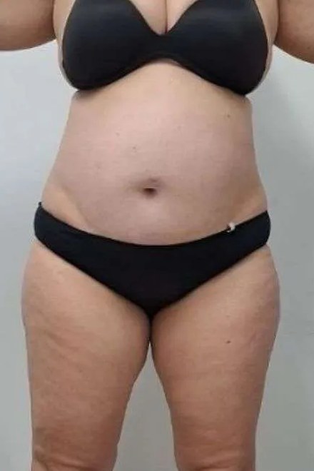 Body po sérii procedur, pohled zepředu