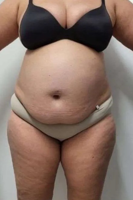 Body před procedurou, pohled zepředu