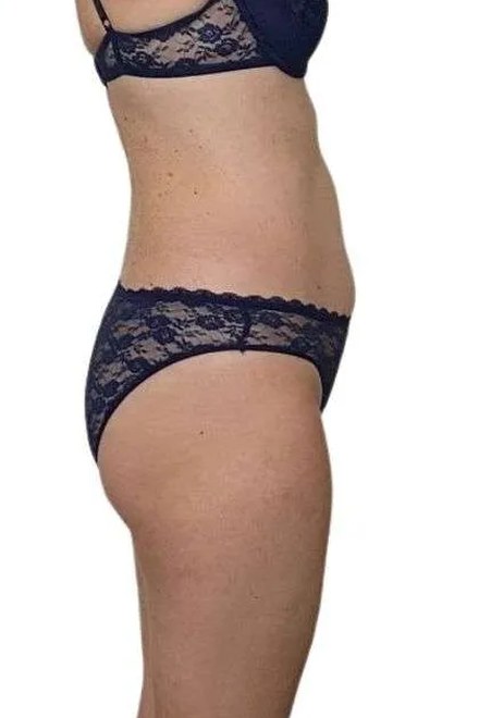 Body po sérii procedur, pohled z boku