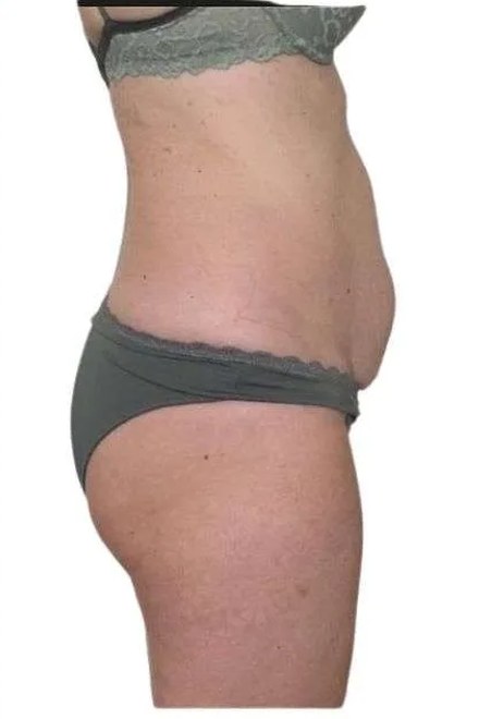 Body před procedurou, pohled z boku