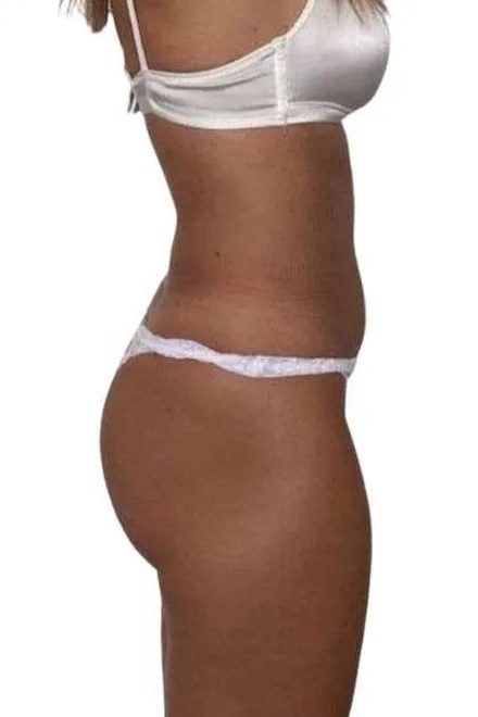 Body po sérii procedur, pohled z boku