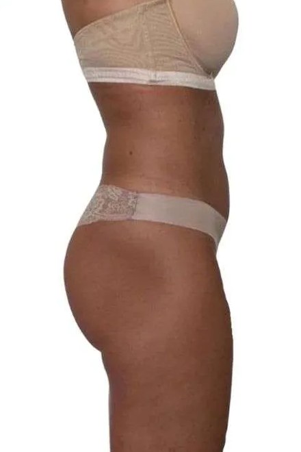 Body před procedurou, pohled z boku