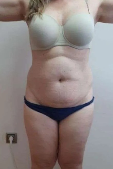 Body po sérii procedur, pohled zepředu