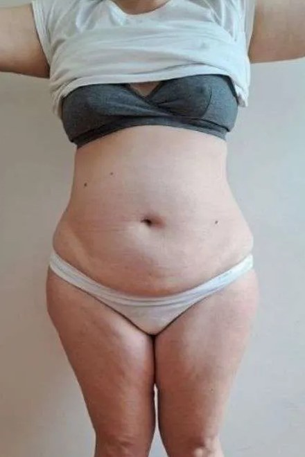 Body před procedurou, pohled zepředu