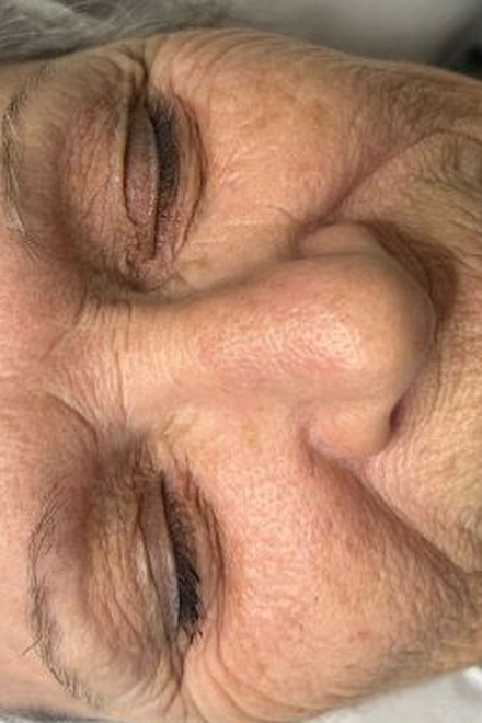 Face před procedurou — Pleť obličeje
